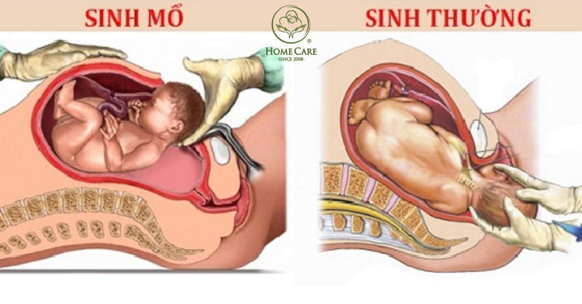 Tìm hiểu về phương pháp sinh thường và sinh mổ