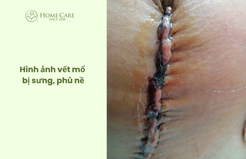 Hình ảnh vết mổ bị sưng, phù nề
